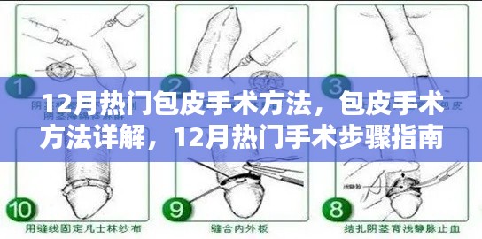 12月热门包皮手术详解与指南，手术方法与步骤解析