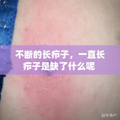 不断的长疖子，一直长疖子是缺了什么呢 